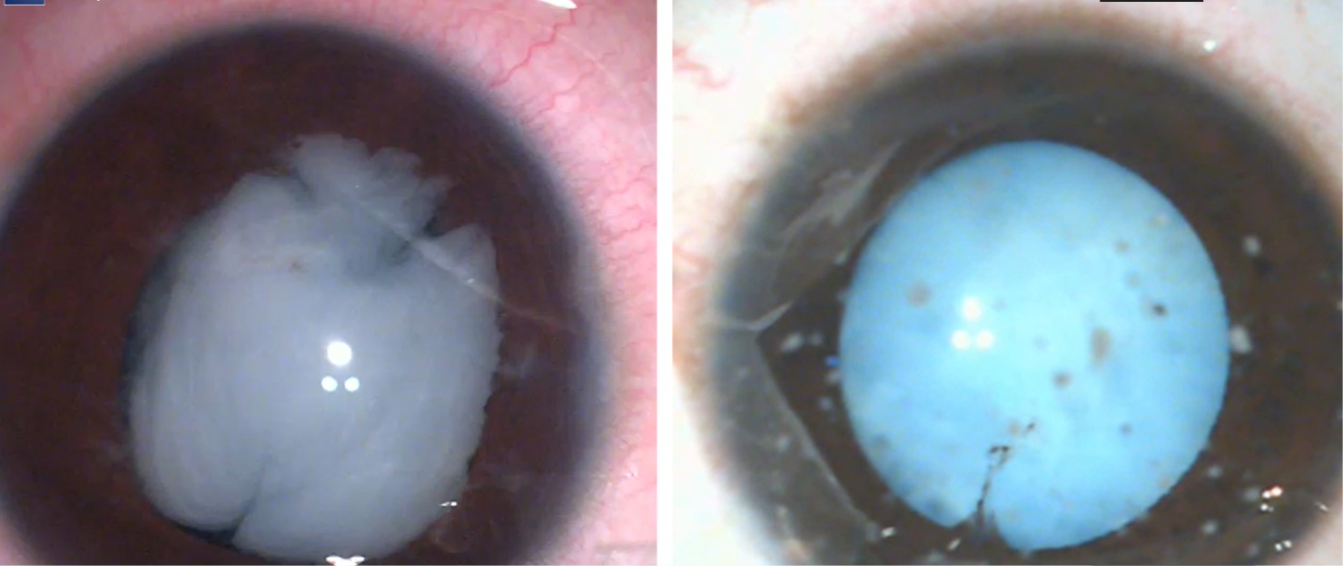 Pediatric Cataract