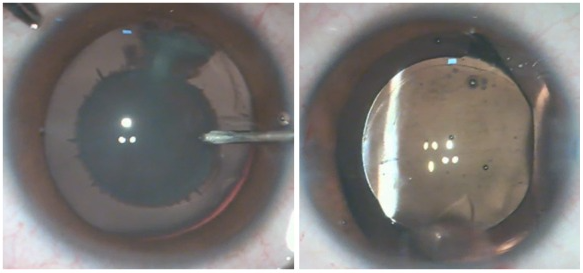 Zonular Cataract Surgery