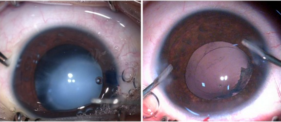 Posterior Lenticonus Cataract