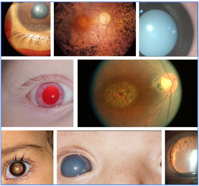 Various genetic eye conditions